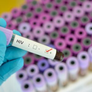 Blood sample with HIV positive